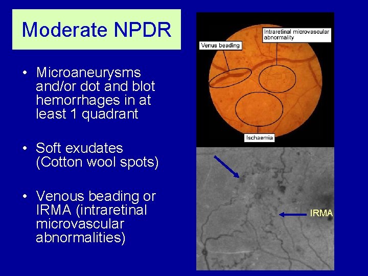 Moderate NPDR • Microaneurysms and/or dot and blot hemorrhages in at least 1 quadrant