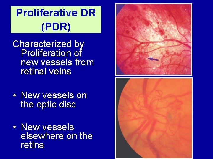 Proliferative DR (PDR) Characterized by Proliferation of new vessels from retinal veins • New
