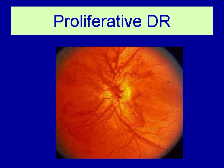 Proliferative DR NVD 