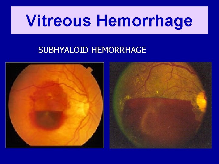 Vitreous Hemorrhage SUBHYALOID HEMORRHAGE 