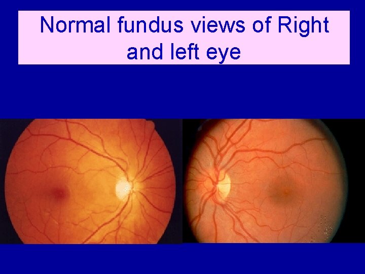 Normal fundus views of Right and left eye 