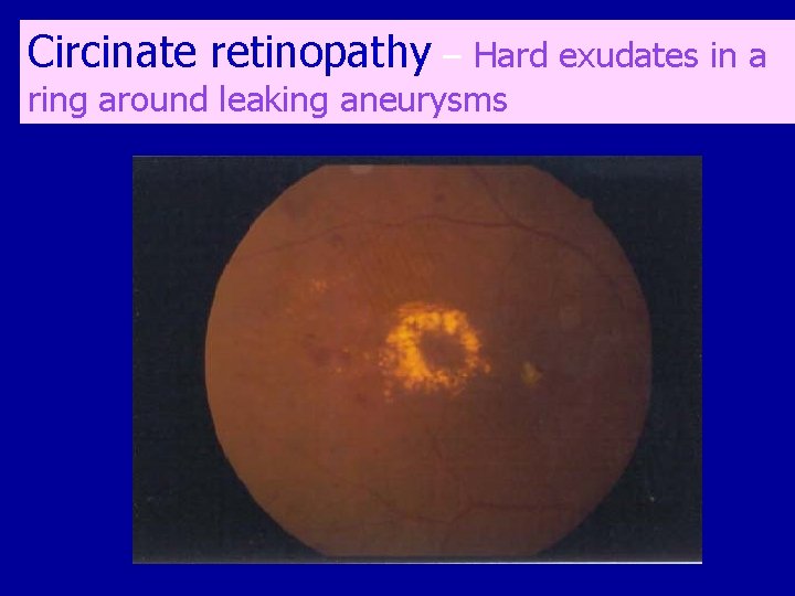 Circinate retinopathy – Hard exudates in a ring around leaking aneurysms 