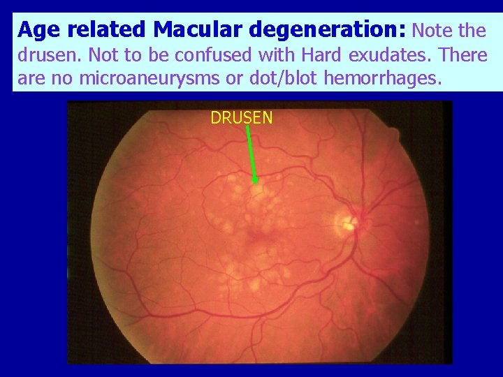 Age related Macular degeneration: Note the drusen. Not to be confused with Hard exudates.