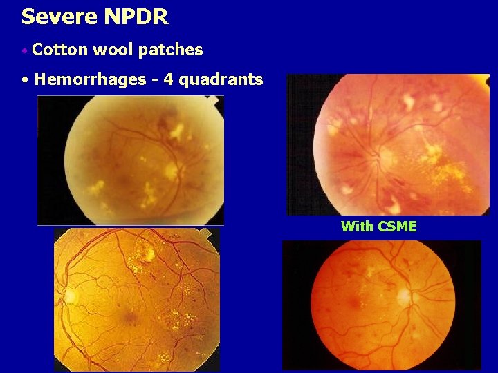 Severe NPDR • Cotton wool patches • Hemorrhages - 4 quadrants With CSME 