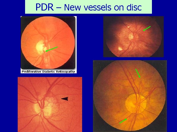 PDR – New vessels on disc 