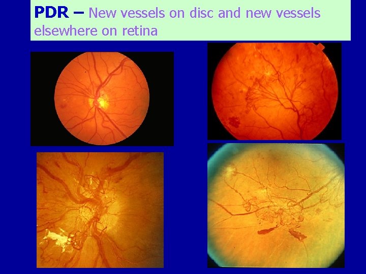 PDR – New vessels on disc and new vessels elsewhere on retina 