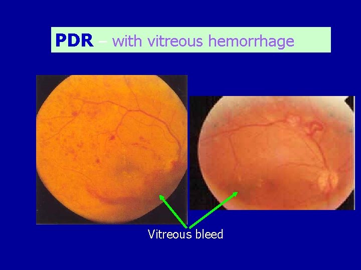 PDR – with vitreous hemorrhage Vitreous bleed 