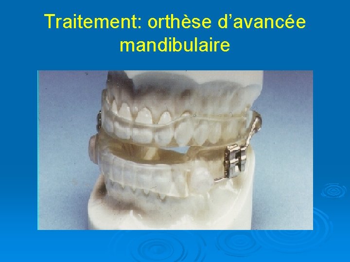 Traitement: orthèse d’avancée mandibulaire 