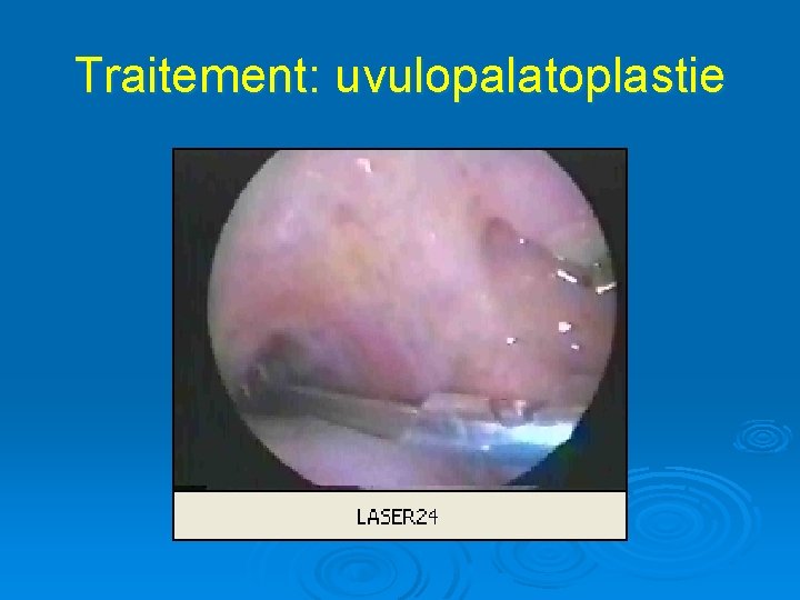 Traitement: uvulopalatoplastie 