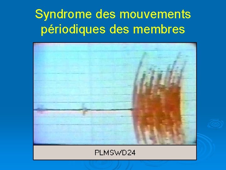 Syndrome des mouvements périodiques des membres 