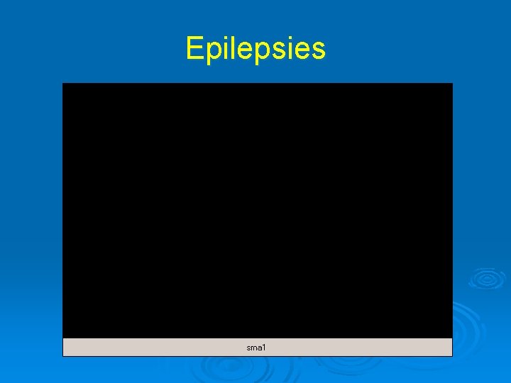 Epilepsies 