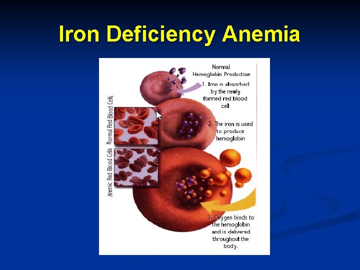 Iron Deficiency Anemia 