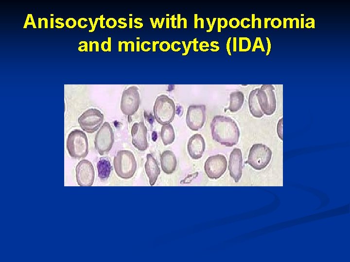 Anisocytosis with hypochromia and microcytes (IDA) 