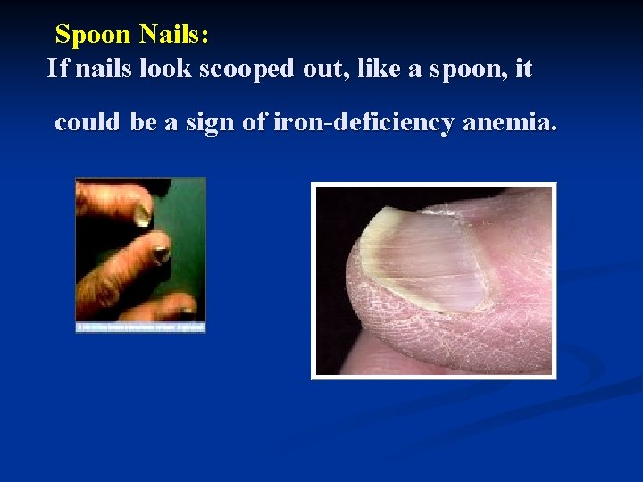 Spoon Nails: If nails look scooped out, like a spoon, it could be a