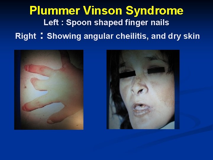 Plummer Vinson Syndrome Left : Spoon shaped finger nails Right : Showing angular cheilitis,