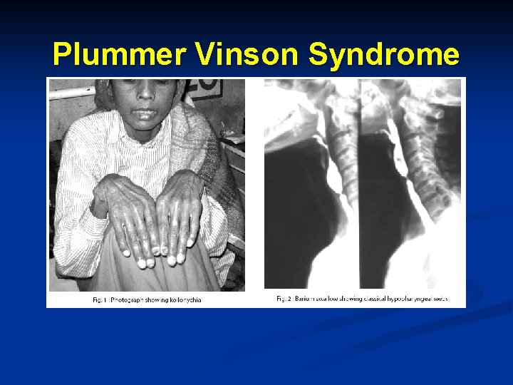 Plummer Vinson Syndrome 