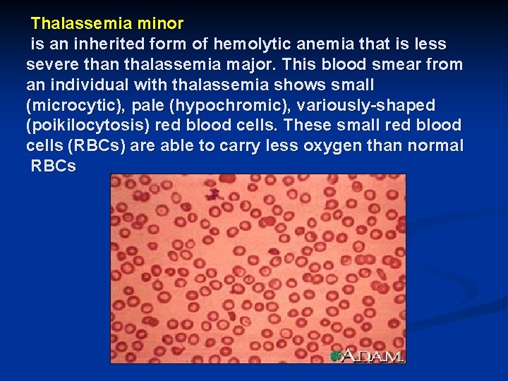 Thalassemia minor is an inherited form of hemolytic anemia that is less severe than