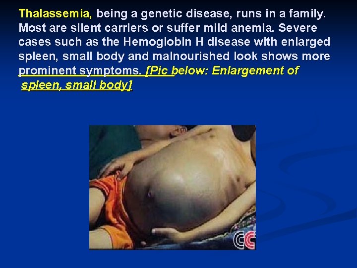 Thalassemia, being a genetic disease, runs in a family. Most are silent carriers or