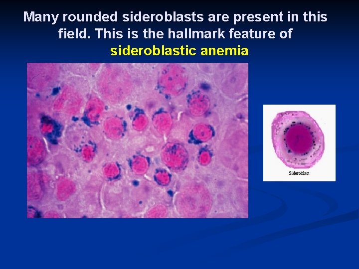 Many rounded sideroblasts are present in this field. This is the hallmark feature of