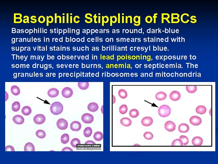 Basophilic Stippling of RBCs Basophilic stippling appears as round, dark-blue granules in red blood