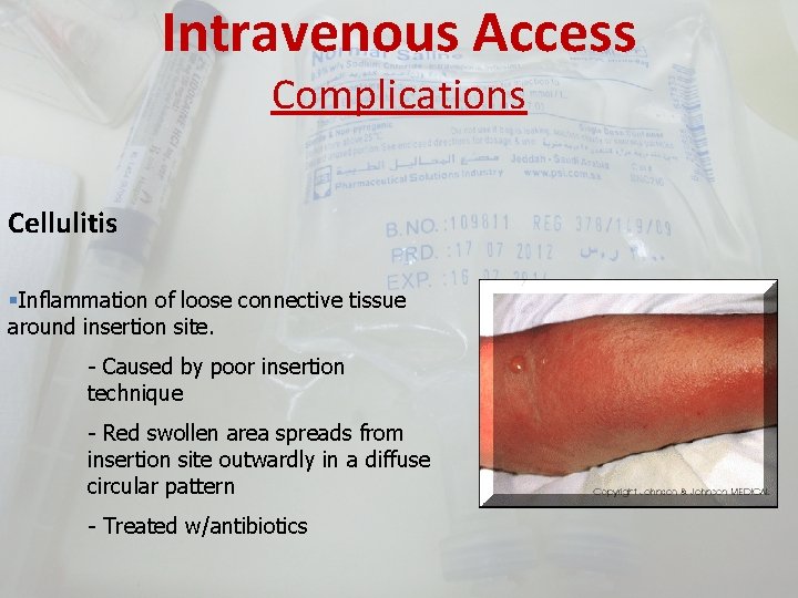 Intravenous Access Complications Cellulitis §Inflammation of loose connective tissue around insertion site. - Caused