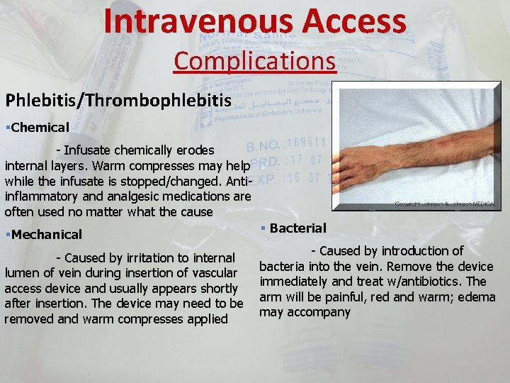 Intravenous Access Complications Phlebitis/Thrombophlebitis §Chemical - Infusate chemically erodes internal layers. Warm compresses may