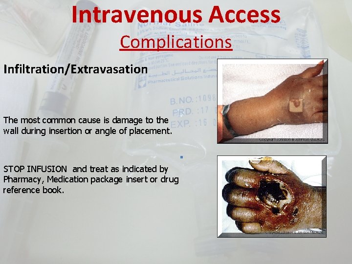 Intravenous Access Complications Infiltration/Extravasation The most common cause is damage to the wall during