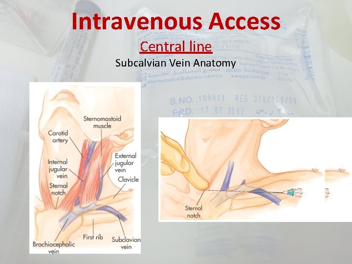 Intravenous Access Central line Subcalvian Vein Anatomy 