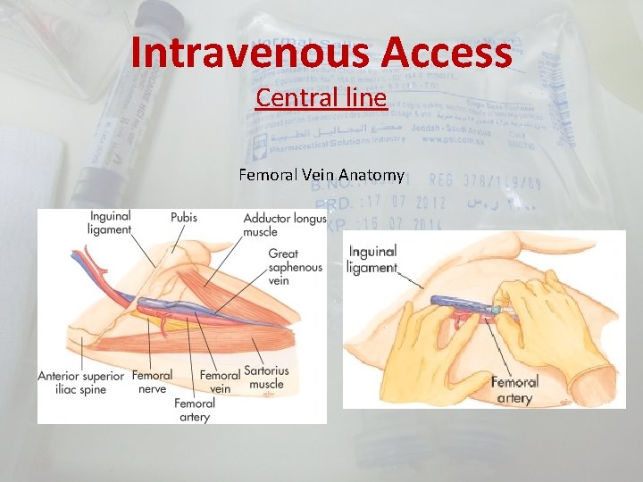 Intravenous Access Central line Femoral Vein Anatomy 