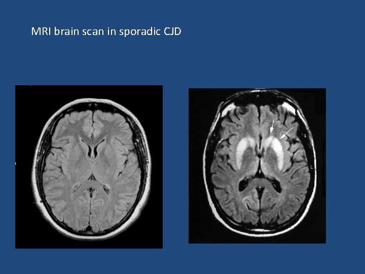 MRI brain scan in sporadic CJD 