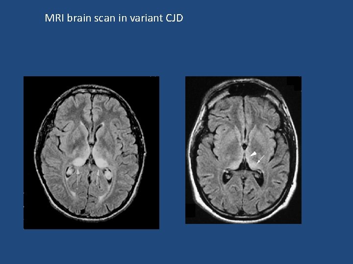MRI brain scan in variant CJD 