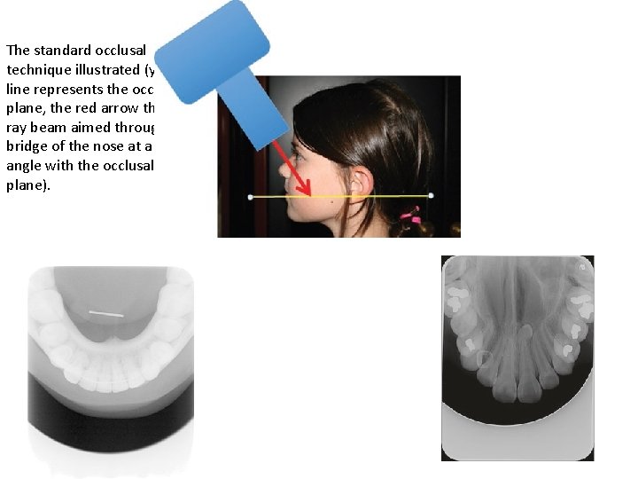 The standard occlusal technique illustrated (yellow line represents the occlusal plane, the red arrow