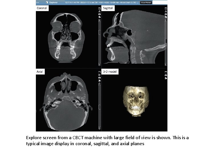 Explore screen from a CBCT machine with large field of view is shown. This