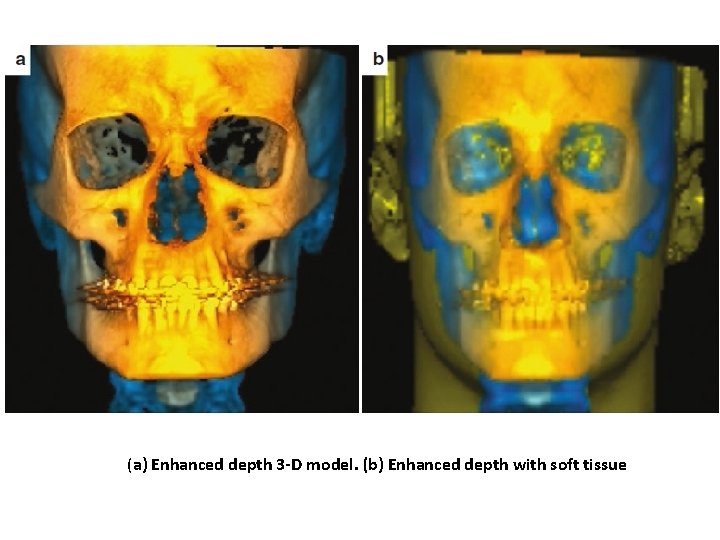 (a) Enhanced depth 3 -D model. (b) Enhanced depth with soft tissue 