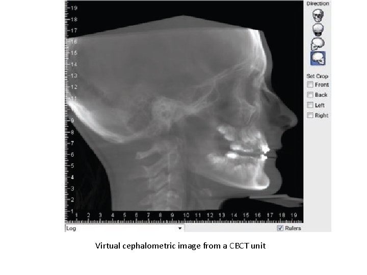 Virtual cephalometric image from a CBCT unit 