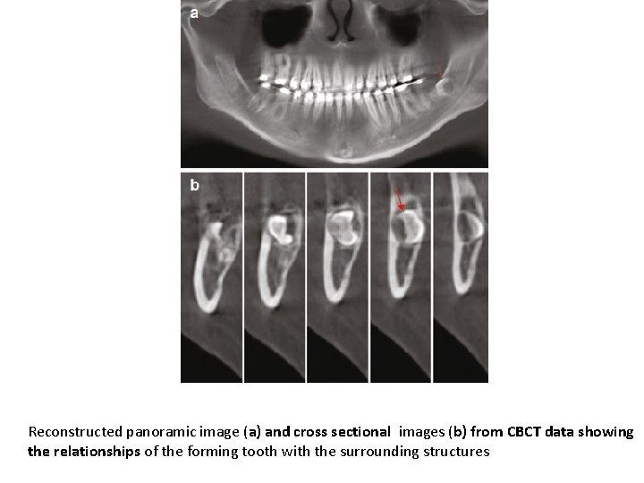 Reconstructed panoramic image (a) and cross sectional images (b) from CBCT data showing the
