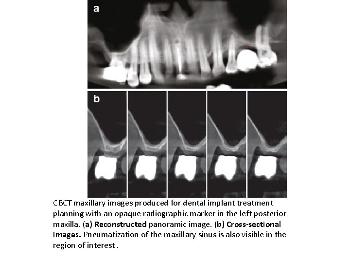 CBCT maxillary images produced for dental implant treatment planning with an opaque radiographic marker