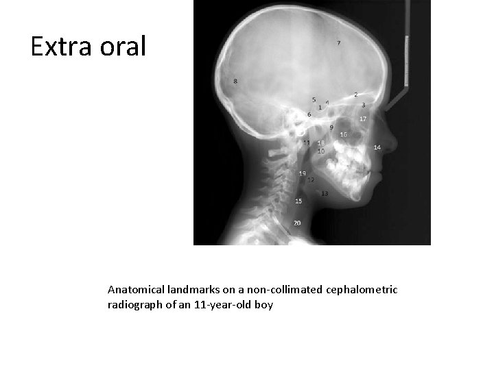 Extra oral Anatomical landmarks on a non-collimated cephalometric radiograph of an 11 -year-old boy