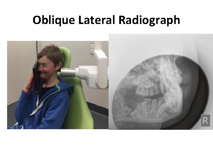 Oblique Lateral Radiograph 