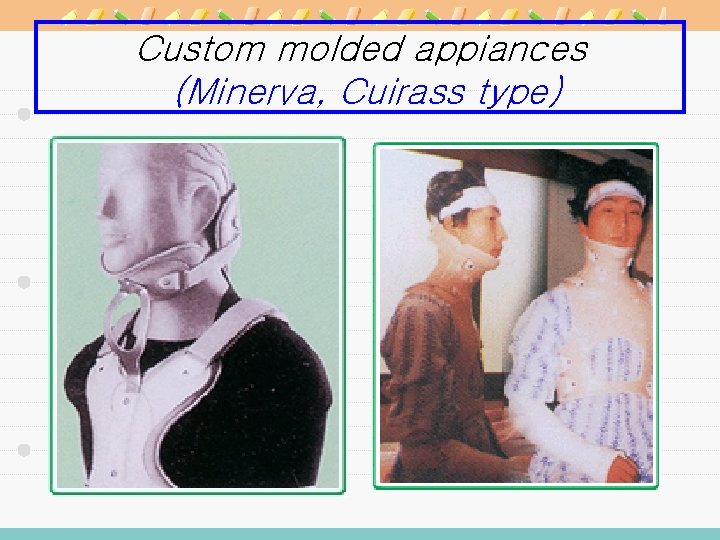 Custom molded appiances (Minerva, Cuirass type) 