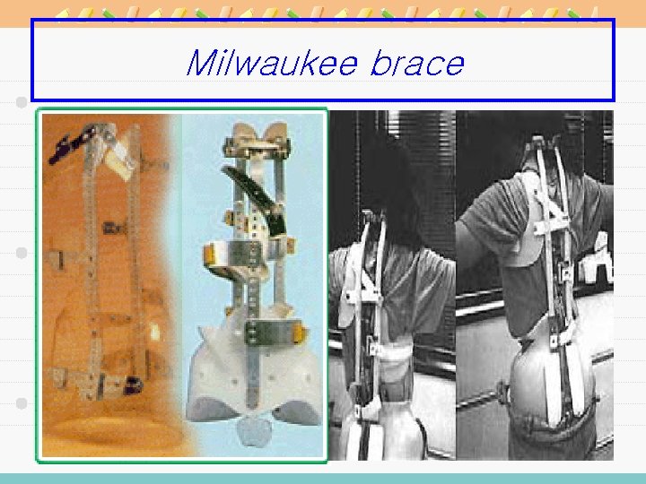 Milwaukee brace 