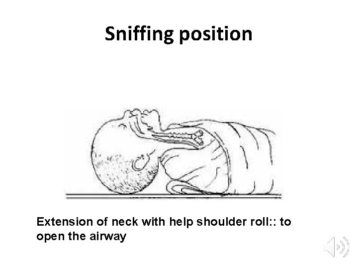 Sniffing position Extension of neck with help shoulder roll: : to open the airway