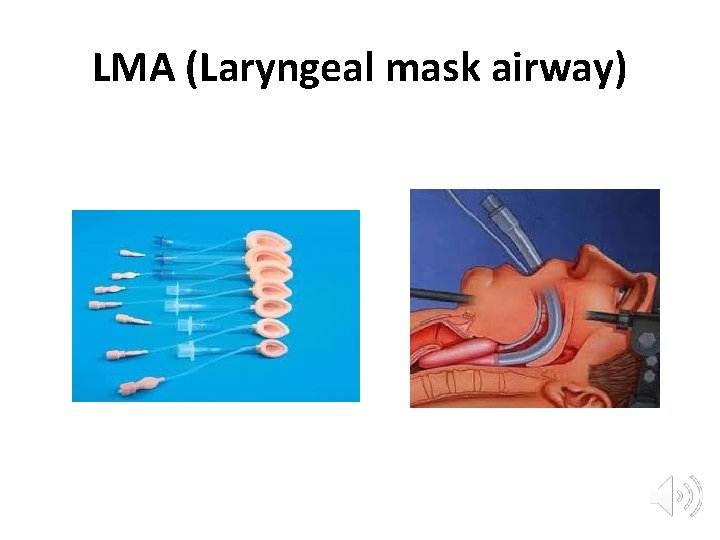 LMA (Laryngeal mask airway) 