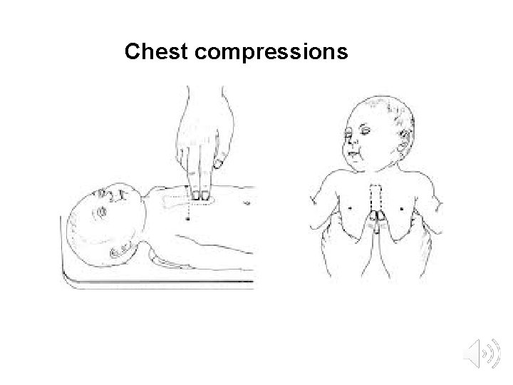 Chest compressions 