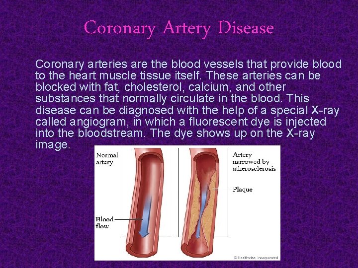Coronary Artery Disease Coronary arteries are the blood vessels that provide blood to the