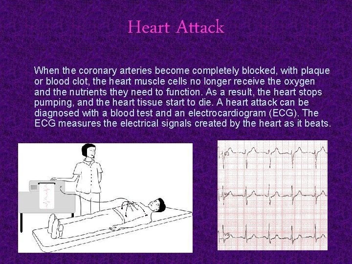 Heart Attack When the coronary arteries become completely blocked, with plaque or blood clot,