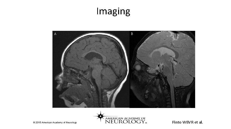 Imaging A © 2015 American Academy of Neurology B Pinto WBVR et al. 