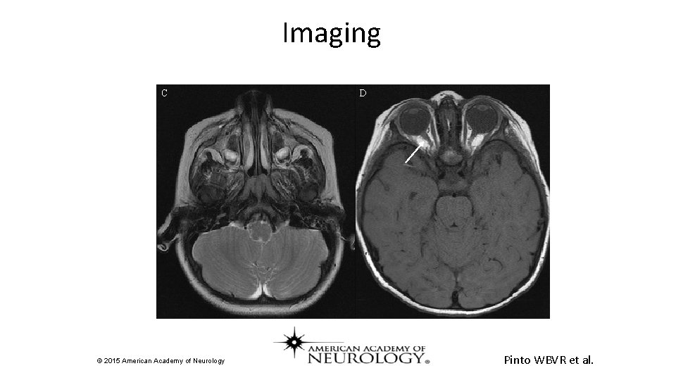 Imaging C © 2015 American Academy of Neurology D Pinto WBVR et al. 