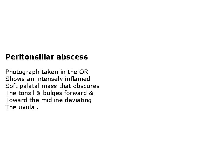 Peritonsillar abscess Photograph taken in the OR Shows an intensely inflamed Soft palatal mass
