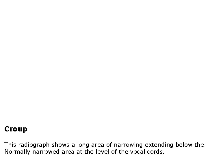 Croup This radiograph shows a long area of narrowing extending below the Normally narrowed